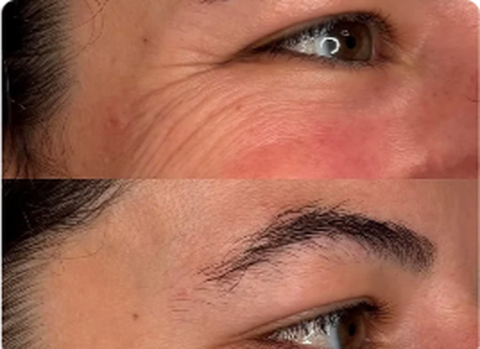 Før og etter-resultat med ScandiSkin Retinal Shot
