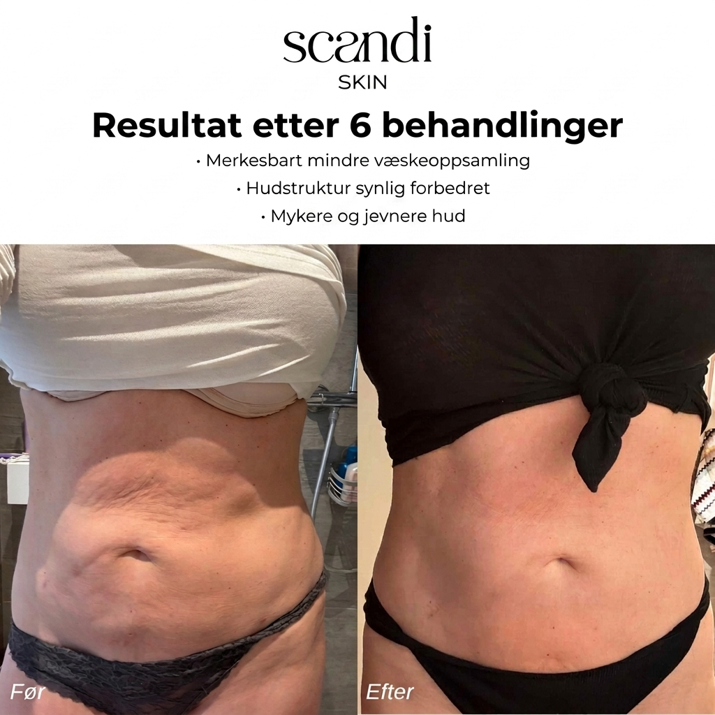 Scandi Smooth – Cellulit massageapparat