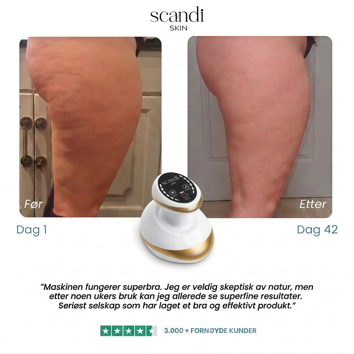 Scandi Smooth – Cellulit massageapparat
