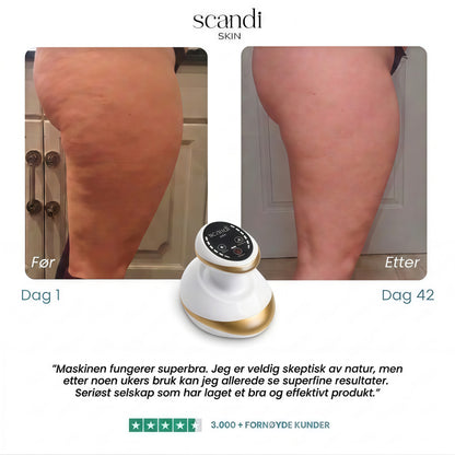 Scandi Smooth – Cellulit massageapparat
