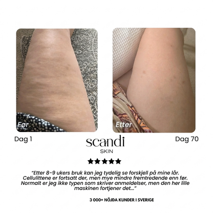 Scandi Smooth – Cellulit massageapparat